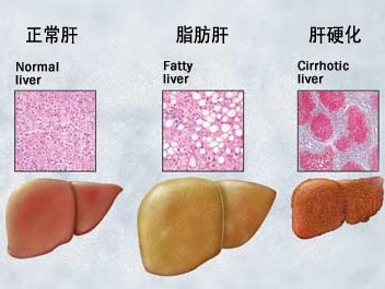 肝硬化能治好吗？